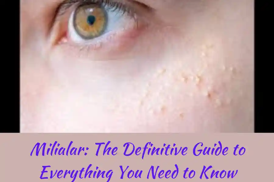 Milialar: The Definitive Guide to Everything You Need to Know